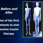 Insuliiniresistenssi – kaikkien elintasosairauksien äiti, osa 2